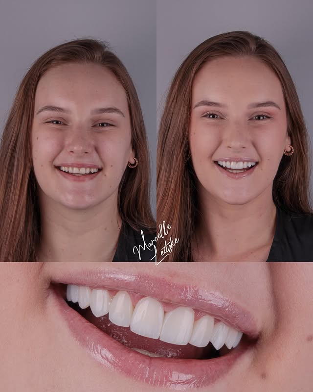 Antes e depois — Lentes em Resina